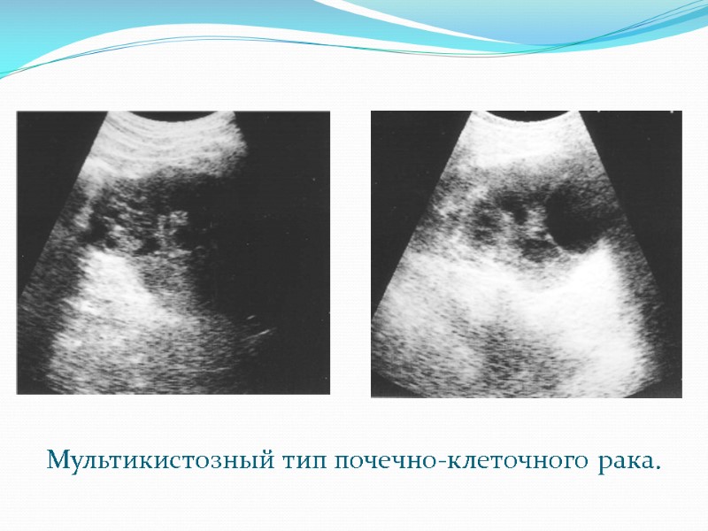 Мультикистозный тип почечно-клеточного рака.